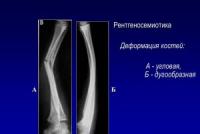 Виды корригирующей остеотомии, реабилитация после операции Корригирующая остеотомия большеберцовой кости реабилитация