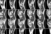 Остеотомия колена и показания к ее проведению Послеоперационное лечение корригирующая остеотомия остеосинтез костей голени
